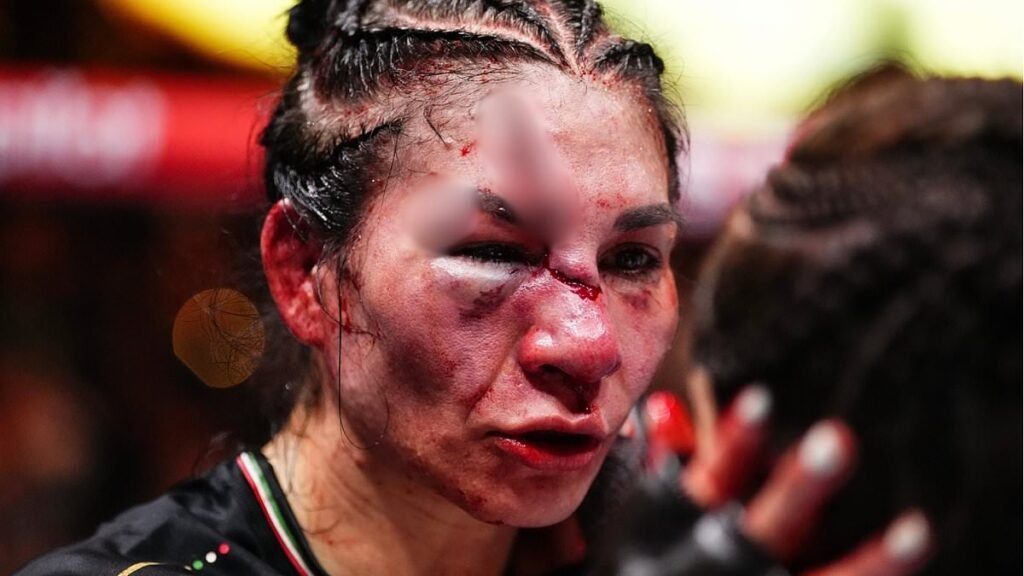 UFC Fans Shocked by Fighter’s Horrific Facial Injury in Las Vegas Fight